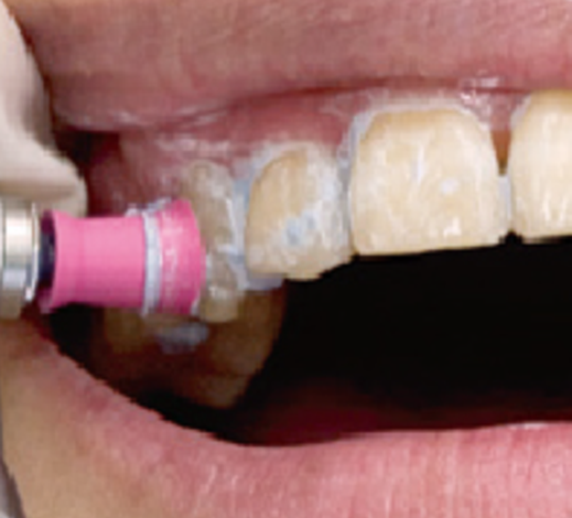 治療説明と歯のクリーニング