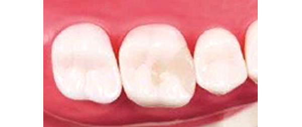 オールジルコニア