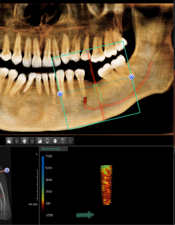 正確な手術のためのサージガイド