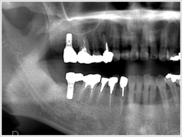 インプラント後