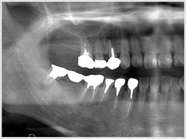 インプラント前