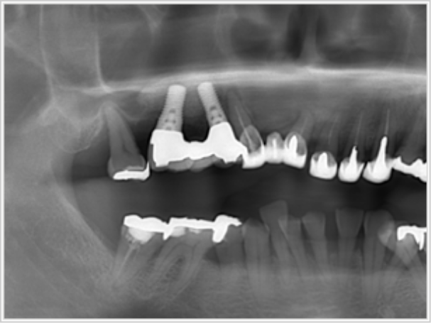 インプラント後