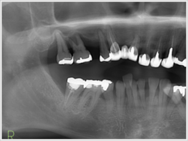 インプラント前