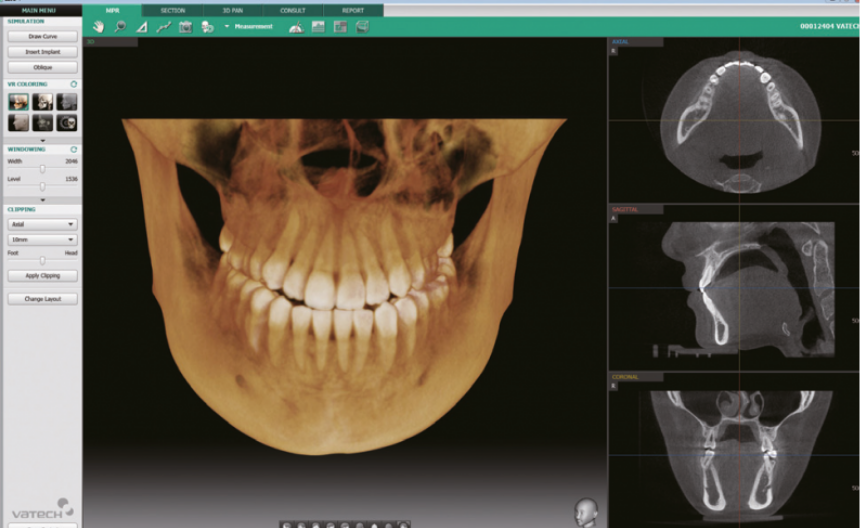 歯科用CTの撮影データ